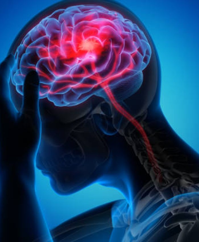 Medical illustration of a brain with stroke symptoms